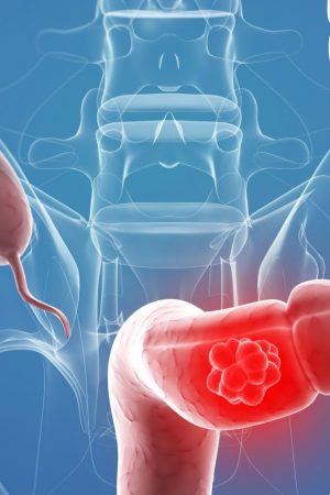 Colorectal-Cancer-Symptoms-and-Treatments