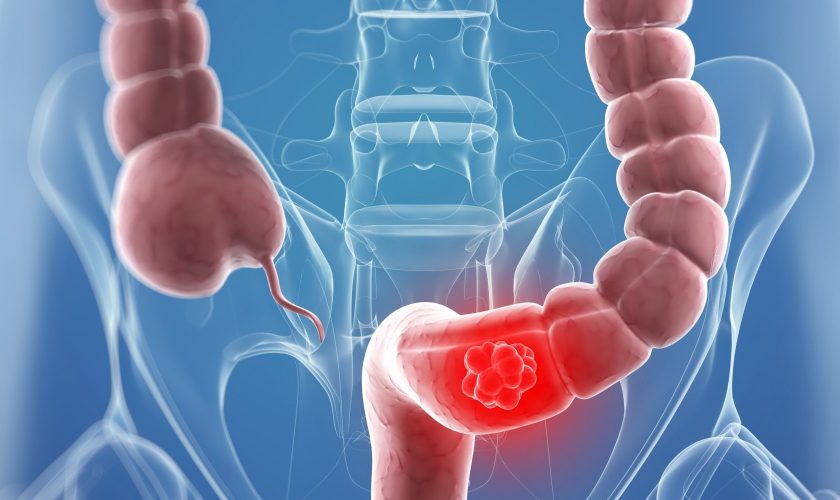 Colorectal-Cancer-Symptoms-and-Treatments