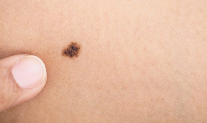 Melanomas-Visible-and-Invisible